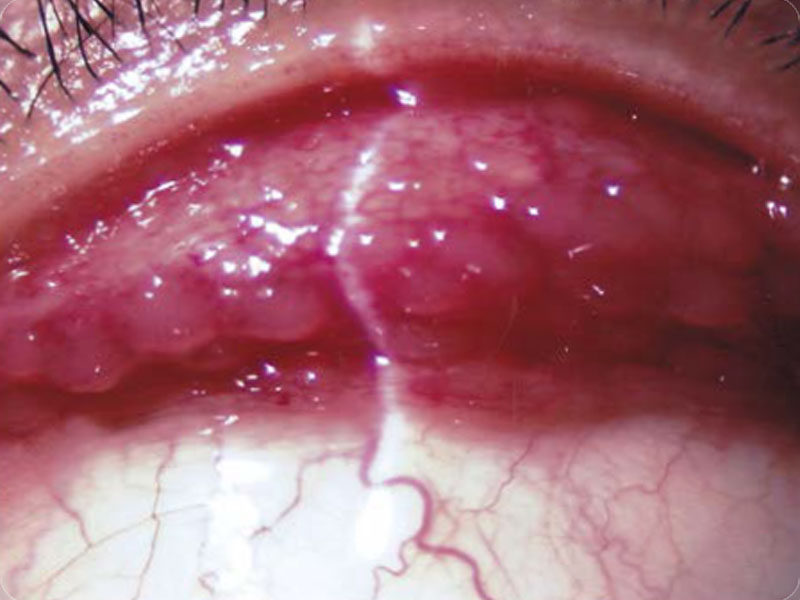 巨大乳頭性結膜炎